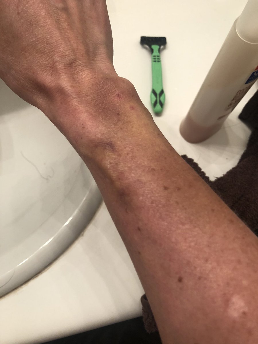 At home recovering week 2 with this lovely drain tube. Morale and bank account are wayyyy down. Infection for a surgery last spring. I pray I’ll get this tube out next week.