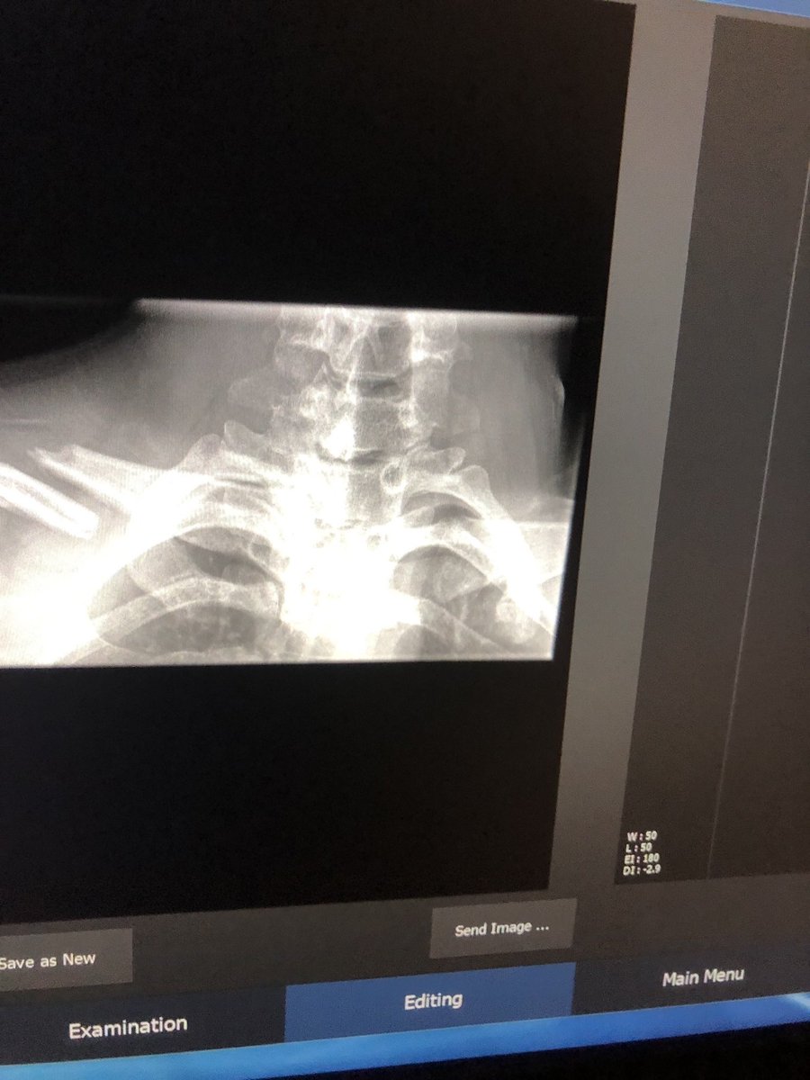 IsaiahRubio17's tweet photo. A year ago today I snapped my collarbone in half, couldn’t even bench the bar without being in pain. Now  I just set my new PR at 280 on bench. Honestly, some good progress if you ask me https://t.co/65E4l2NvdP