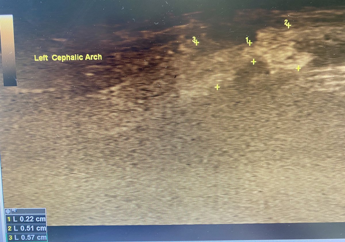 robshahverdyan's tweet photo. Who needs an angio, when you have  #bflow 💪🏼 ….. oh, and mad ultrasound skills 🤪. #BCAVF. Cephalic arch with previous stentgraft, now Qa dropped to 350ml/min, PI is at 0.88. Not much at first sight. Peripheral edge stenosis detected by b-flow. https://t.co/gIYK0zlfid