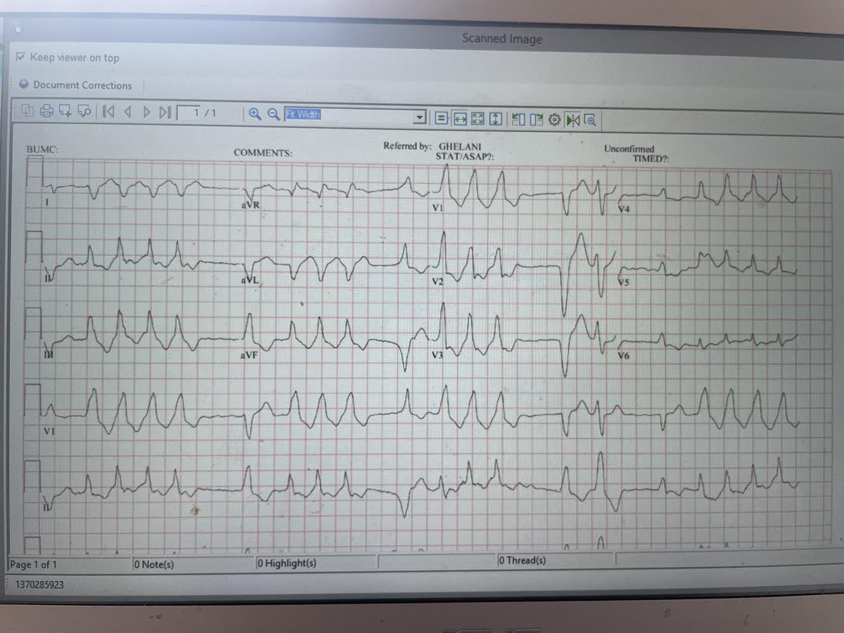 Dizziness, AICD fired, looks pale