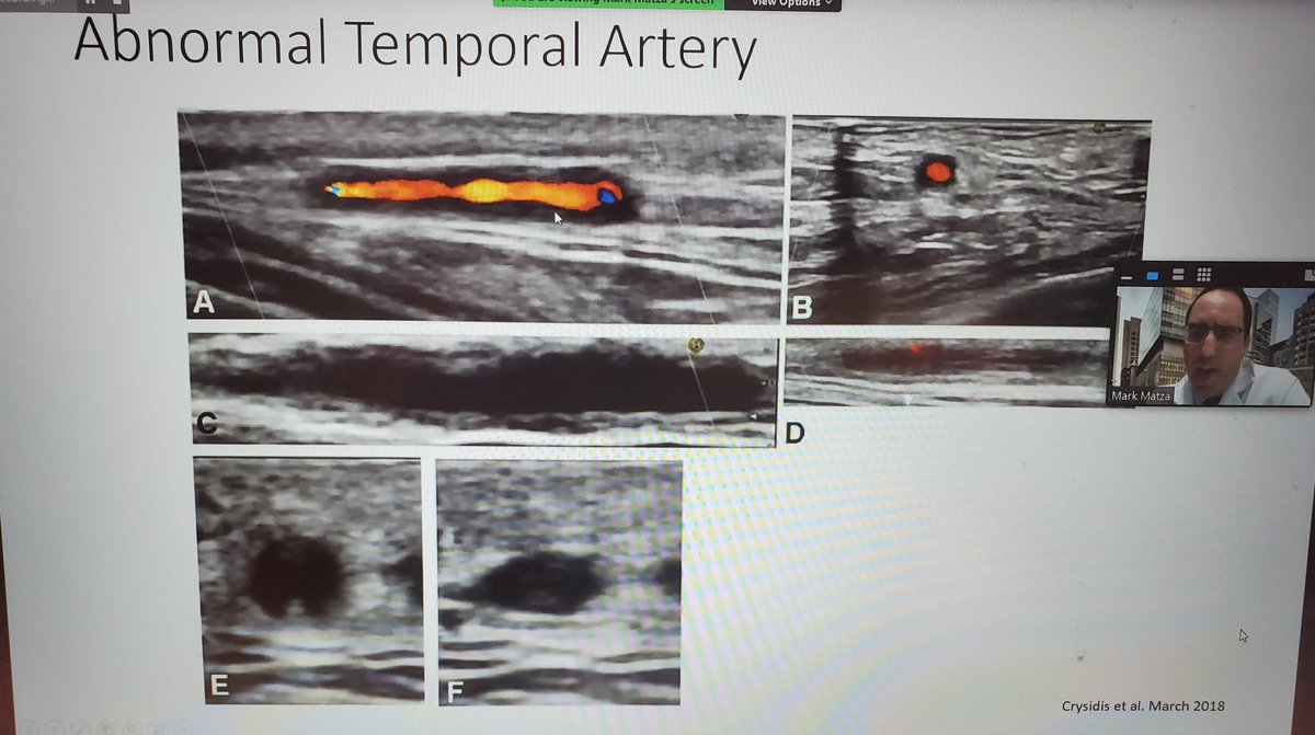 USSONAR (@ussonar_rh) on Twitter photo HALO Sign by ultrasound in Giant Cell Arteritis #ussonar #POCUS #vasculitis #rheumtwitter <a href="/markmatzamd/">Mark A. Matza, MD, MBA, RhMSUS</a> <a href="/MGH_MSUS/">MGH Rheumatology MSK Ultrasound Program</a> #ultrasound HALO Sign by ultrasound in Giant Cell Arteritis #ussonar #POCUS #vasculitis #rheumtwitter <a href="/markmatzamd/">Mark A. Matza, MD, MBA, RhMSUS</a> <a href="/MGH_MSUS/">MGH Rheumatology MSK Ultrasound Program</a> #ultrasound