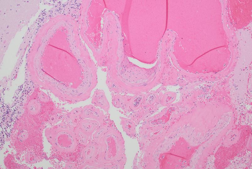 MayoClinicPath's tweet photo. 1/
A new #ForensicFriday question with Dr. Reade Quinton and @theNAME1966  is coming right up!  This week’s case comes from Dr. Leo Yenwongfai (PGY2 resident) and Dr. Gregory J. Davis (Professor, University of Kentucky College of Medicine).
#pathtwitter #APpath https://t.co/2JgRjwuJ0O