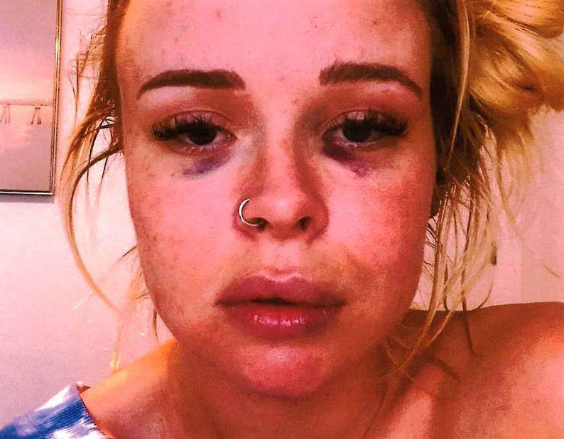 HUNTER Alleged 'rough sex' victim of Dodgers' Trevor Bauer reveals injuries