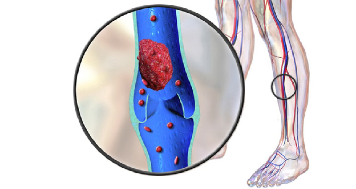 Тромбоз сосудов нижних