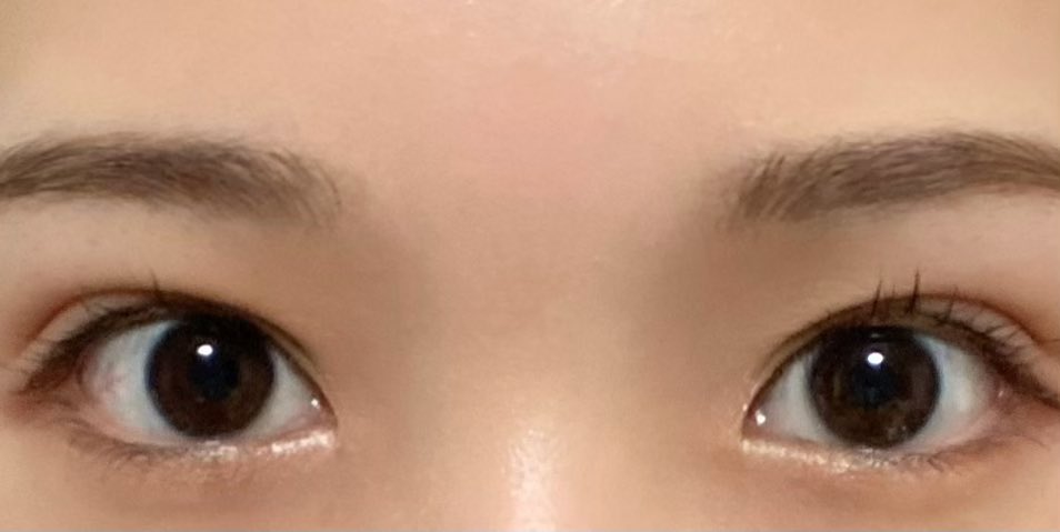 sk_mk23's tweet photo. 全切開DT23日目。
メイクして目開けた状態だとだいぶ自然🥰
やる前毎日悩んでたことを考えると、本当にやってよかった🌟
#二重整形
#全切開
#DT23日目 https://t.co/4jslOIepgT