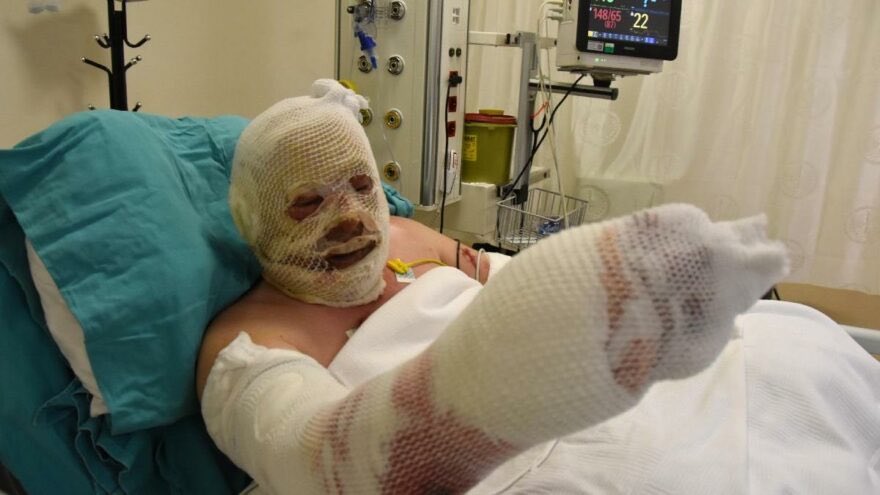 alpertuydes's tweet image. Ormana her çöp attığınızda, yanan ormanı korumaya çalışırken bu hale gelen kahraman ormancı Yaşar Kozakbaş gelsin aklınıza.