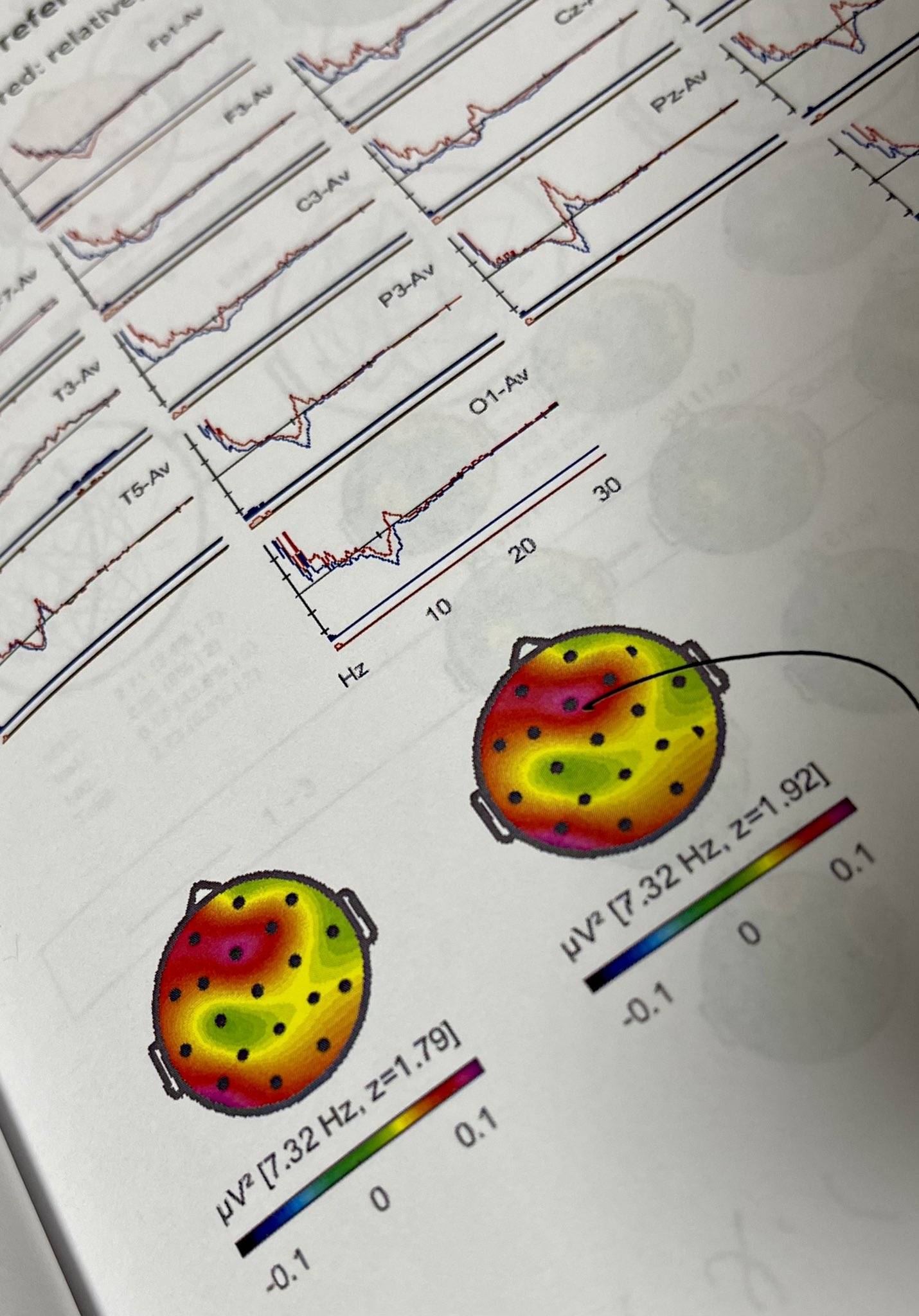 水落立平 篠笛 発達障害専門の病院で脳波の検査をしました Adhd中等度 Asd低等度の併発という結果に そりゃあ今まで職業を転々として どれもうまくいかなかった訳ですな 笛を作っているときは過集中 いわゆるゾーンに入る状態なんだと思います