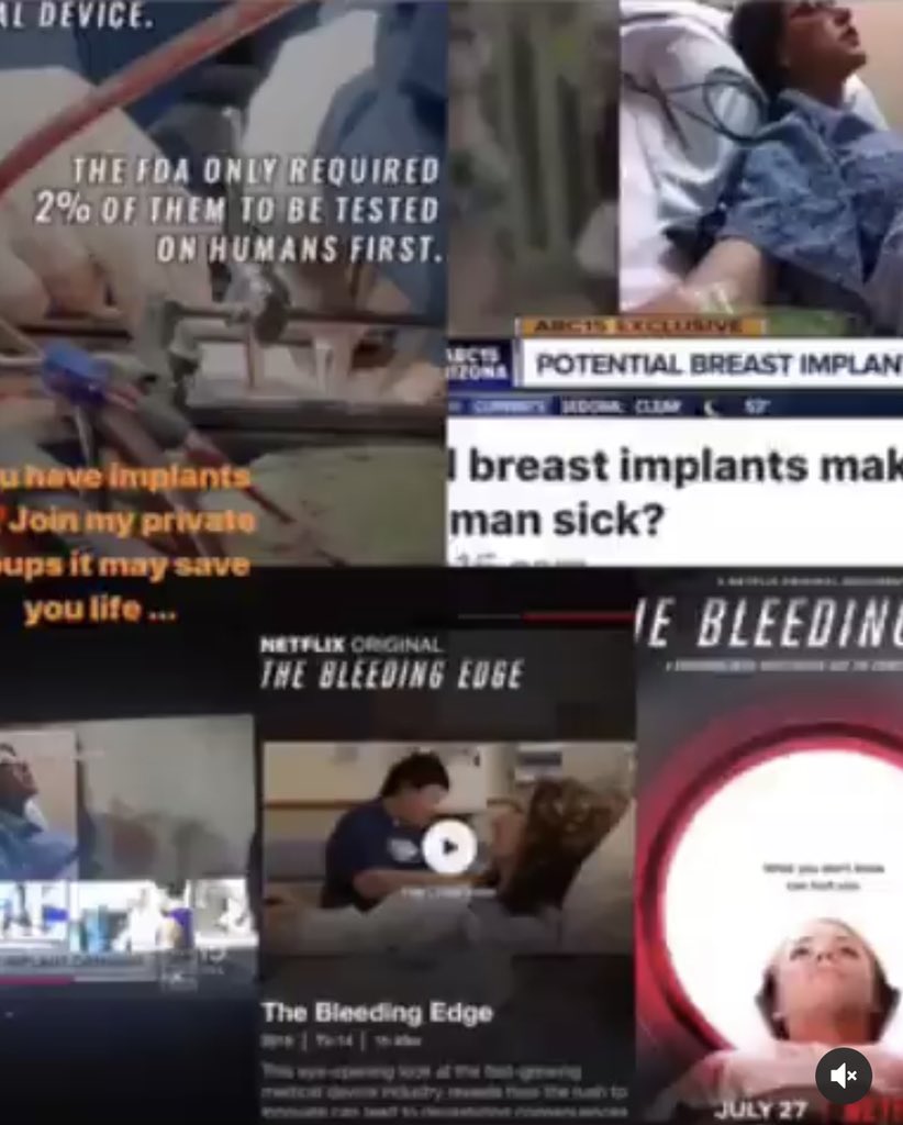 hairdoctk's tweet image. Watch my ted talk for the full story m.youtube.com/watch?v=NOkOZZ… #breastimplants #implanted #implanteddevices #breastaugmentation  #breastcancer #cancers #WomenSupportingWomen #corruption
