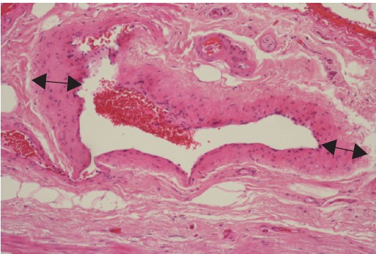 Neovascularisation 
 is one of the main causes of varicose vein recurrence. Why?
"Histopathology of Neovascularisation Observed During Saphenofemoral Re-Do High Ligation" by M. Ehrler et al.
Read the details #openaccess in #EJVESforum
ejvesreports.com/article/S2666-…