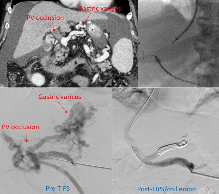 rahulshethmd's tweet photo. Cirrhosis c/b chronic main portal vein occlusion and recalcitrant bleeding from gastric varices, treated with trans-splenic portal vein recanalization+TIPS. There’s nothing quite like pulling a wire from the neck, through the liver, and out the spleen! @PeimanH_VIR @SIRRFS https://t.co/zIDOAVgnuJ