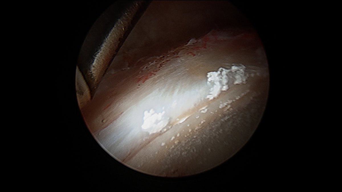 JoshuaHarrisMD's tweet image. This is what a couple previous cortisone injections will look like during #hip #arthroscopy 

Interesting only on acetabulum, not on femoral head.

Do you think these "crystals" (which, by the way, are almost impossible to get out without removing the cartilage) are a problem?