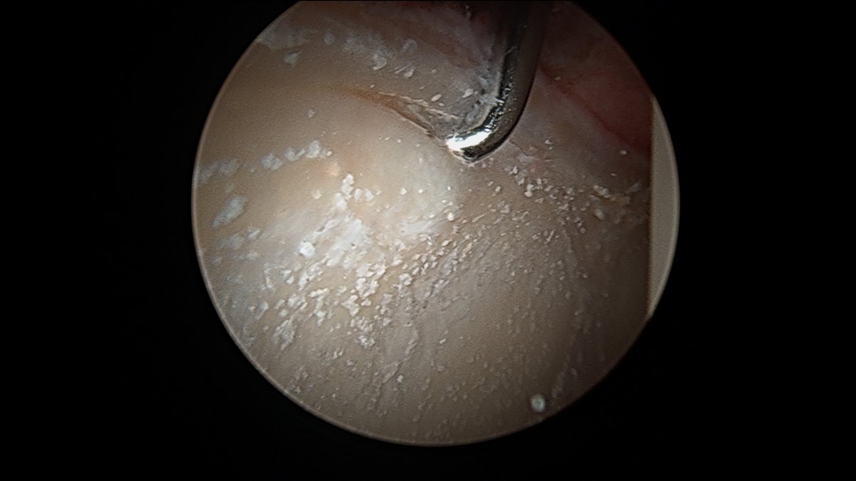 JoshuaHarrisMD's tweet image. This is what a couple previous cortisone injections will look like during #hip #arthroscopy 

Interesting only on acetabulum, not on femoral head.

Do you think these "crystals" (which, by the way, are almost impossible to get out without removing the cartilage) are a problem?