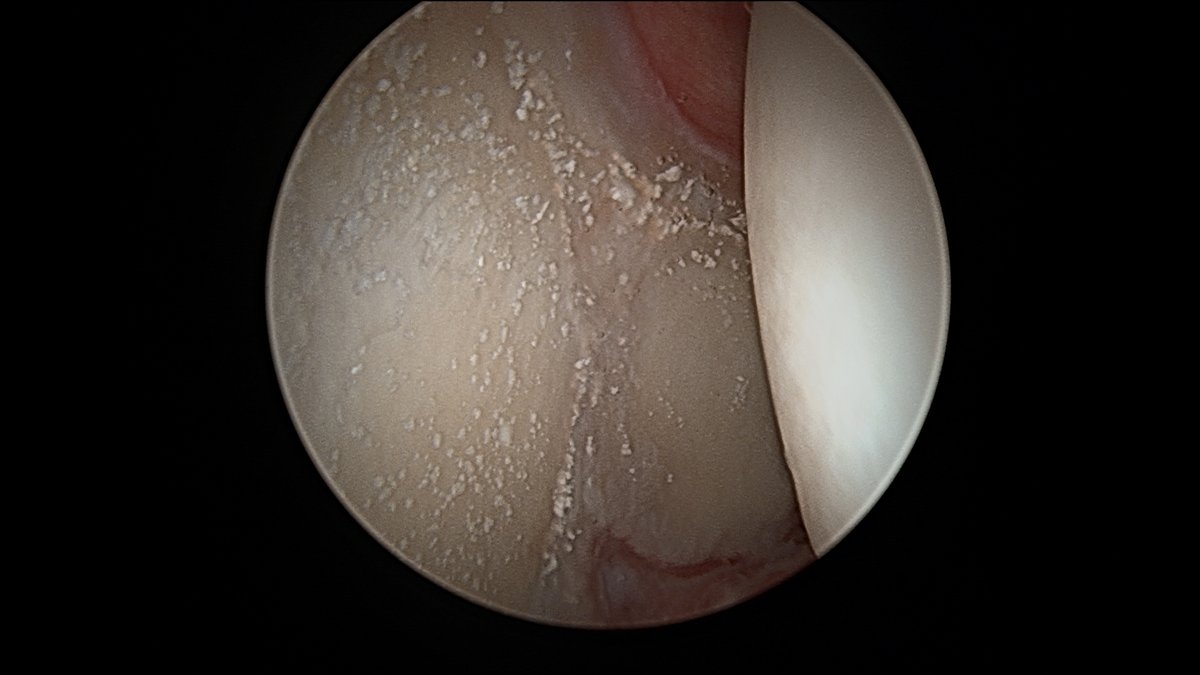 JoshuaHarrisMD's tweet image. This is what a couple previous cortisone injections will look like during #hip #arthroscopy 

Interesting only on acetabulum, not on femoral head.

Do you think these "crystals" (which, by the way, are almost impossible to get out without removing the cartilage) are a problem?