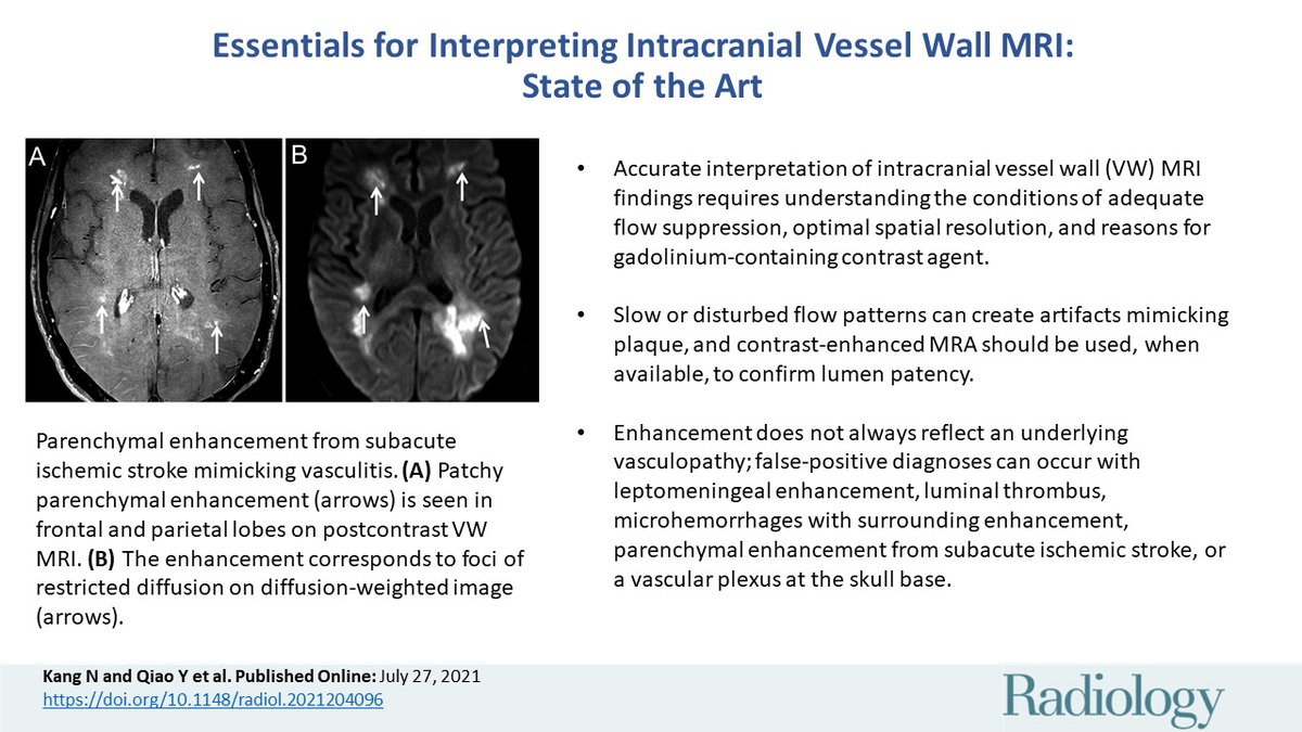 What do you need to perform and interpret intracranial vessel wall imaging? How do you minimize artifacts? Read more. bit.ly/3C9xSBL <a href="/NingdongK/">Ningdong Kang</a> <a href="/qiaoyale/">Ye Qiao</a> <a href="/WassermanBruce/">Bruce A. Wasserman</a> <a href="/Hopkins_Rad/">Johns Hopkins Radiology</a> <a href="/UMmedschool/">University of Maryland School of Medicine</a> <a href="/UMMCRadiology/">UMMCRadiology</a>