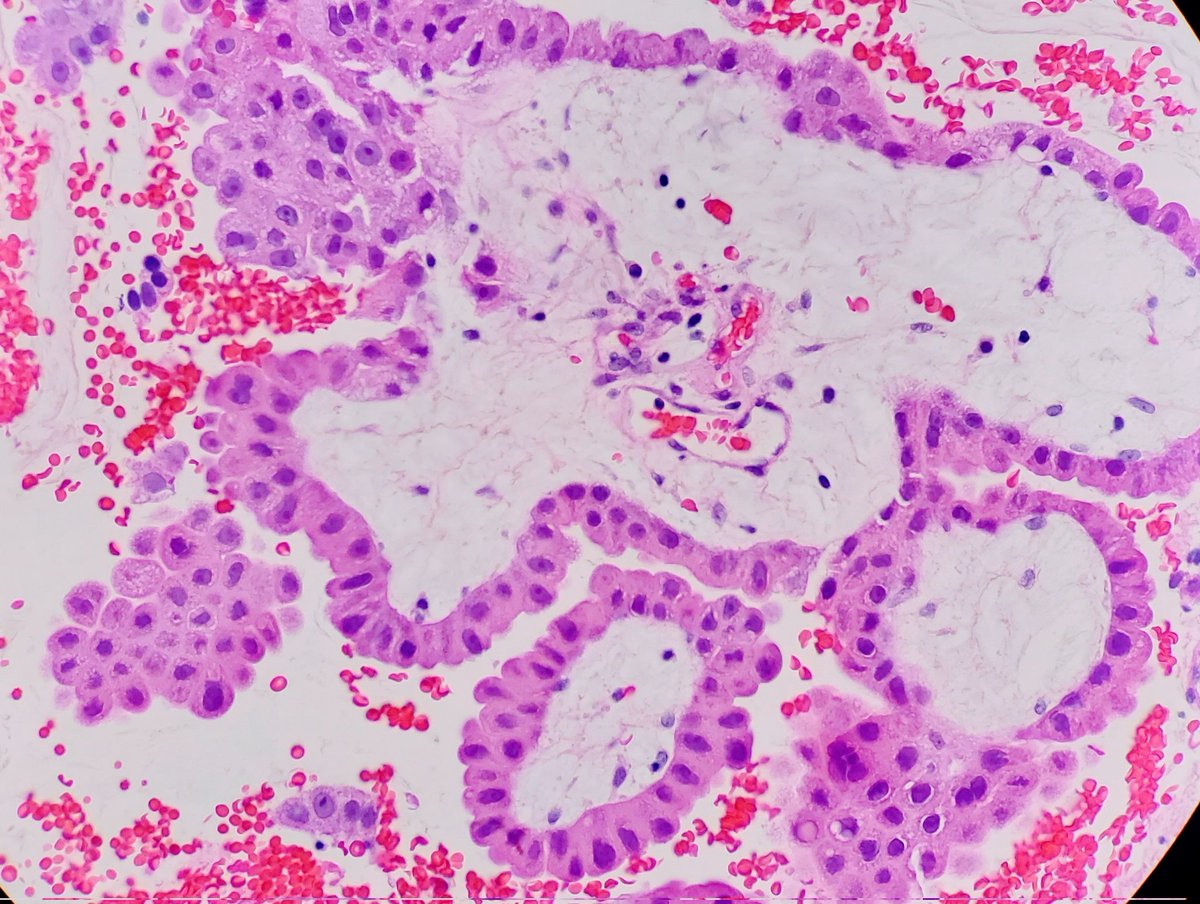 Intraductal Oncocytic Papillary Neoplasm of the Pancreas.