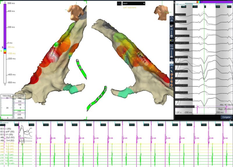 Paciente SM 25 años, Deportista. Hallazgo reciente de MCD no isquemica fevi 30% sin RTG en RM. EV TSVD 30% en holter. Ablacion exitosa, a la derecha superposición de pacemapping y EV clínica. <a href="/alvaro_rivara/">Alvaro Rivara</a> <a href="/CardiocentroAE/">Cardiocentro - Asociación Española</a>