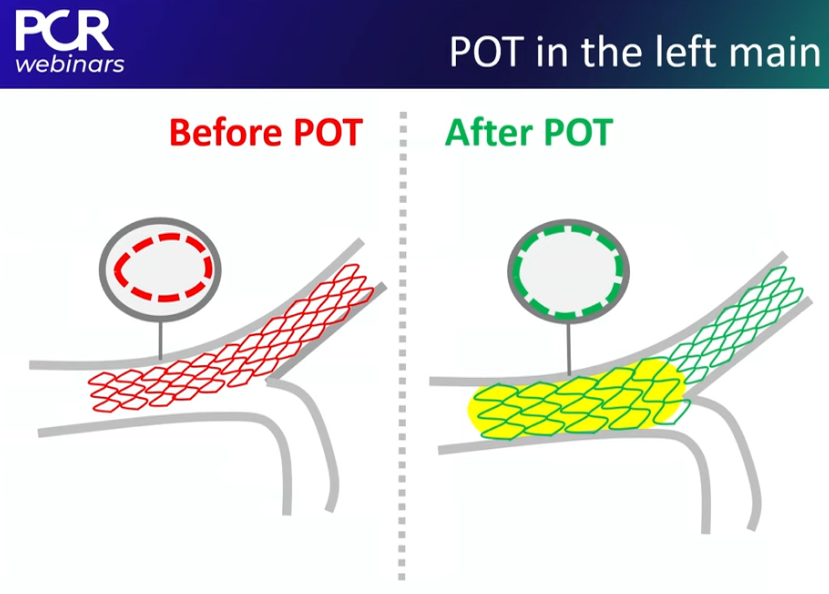 PCRonline's tweet photo. How should I treat the left main in a patient with ACS? In the replay of the 1st episode of the #PCRWebinars on the Road series @SengottuveluG discusses the major challenge of complex distal #bifurcation LM stenting with @kiadeb87 & @MilasinD18
View 📺https://t.co/8GxgTtV0tx https://t.co/Mn0qKGNqcl