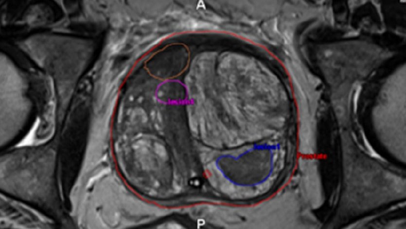 Which is the optimal approach for detection of clinically significant  #prostate #cancer? Current evidence assessed in the last CamPARI-Clinic paper just published on <a href="/BJR_Radiology/">BIR Journals</a>. 
Outstanding Cambridge-Rome collaboration! #UroSoMe
pubmed.ncbi.nlm.nih.gov/34357796/