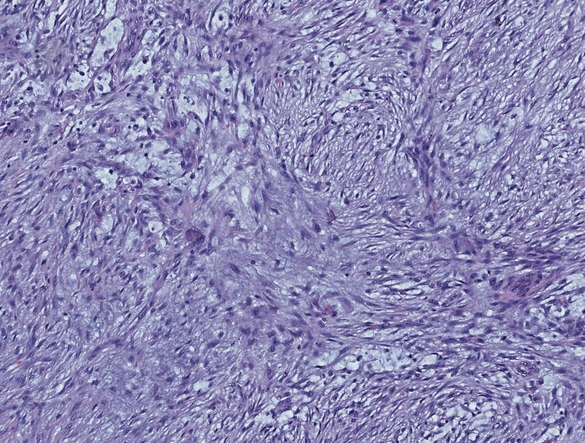 JMGardnerMD's tweet photo. 2cm nodule on forearm of 35 yo woman. No history of trauma. Any stains or molecular needed? Or can you diagnose on H&amp;E only? Reply then check answers here: https://t.co/SsohgBxpRv. #pathology #pathologists #pathTwitter #dermpath #dermatology #dermatologia #dermtwitter #BSTpath https://t.co/NtGKItWFVg