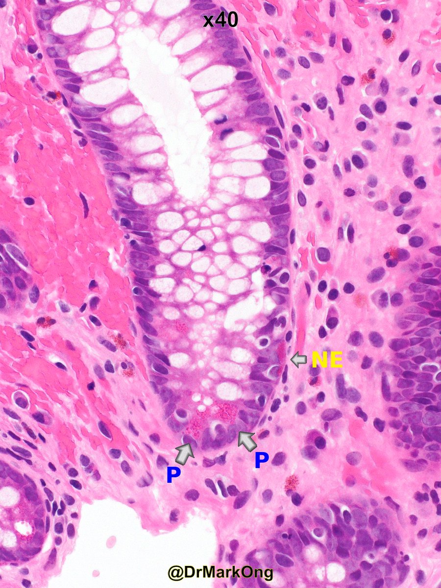 DrMarkOng's tweet photo. Sigmoid colon with now quiescent ulcerative colitis.

Residual Paneth cell metaplasia. Their cytoplasm contain large eosinophilic granules that face the lumen.

In contrast, neuroendocrine cells have much smaller granules that face the basement membrane.

#GIpath https://t.co/dv4GLDKprT