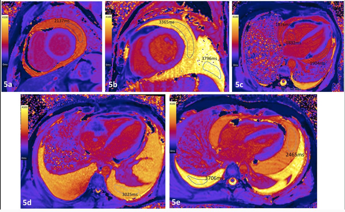EHJCVI Editor-in-Chief (@ehjcvieic) on Twitter photo Non-invasive characterization of pleural and pericardial effusions using T1 mapping by magnetic resonance imaging
doi.org/10.1093/ehjci/…
#EHJCVI #EACVI #EACVI #EACVIPresident
<a href="/ESC_Journals/">European Society of Cardiology Journals</a> Non-invasive characterization of pleural and pericardial effusions using T1 mapping by magnetic resonance imaging
doi.org/10.1093/ehjci/…
#EHJCVI #EACVI #EACVI #EACVIPresident
<a href="/ESC_Journals/">European Society of Cardiology Journals</a>