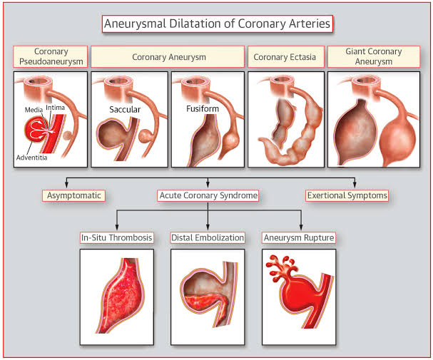 smexcardiologia's tweet photo. Ectasia coronaria ➡️ dilatación difusa 1.5 veces del segmento adyacente normal. 

Aneurisma coronario ➡️ dilatación focal 1.5 veces del segmento adyacente normal. https://t.co/JrMN3bKIq5