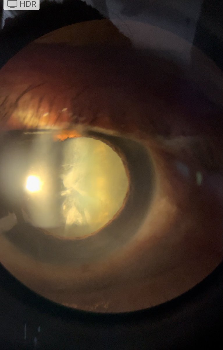 Your daily dose of cataract