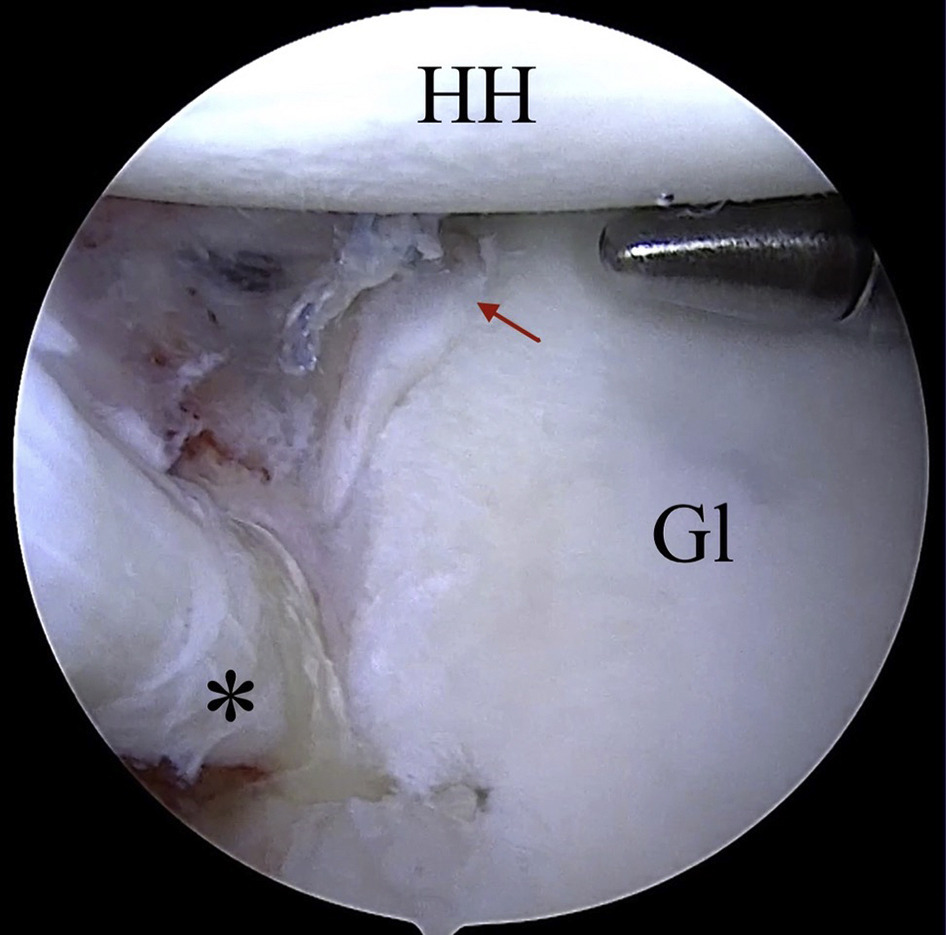 Arthroscopic Bankart repair with arthroscopic subscapularis augmentation (ASA) is an effective treatment for collision/contact sport athletes and patients with hyperlaxity and glenoid bone loss <15%. #shoulder #instability #arthroscopy ow.ly/9KV050FI21f