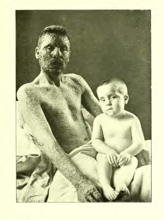 Matrimonio con 3 hijos. Uno enfermó de viruela y rápidamente los médicos recomendaron vacunarse a toda la familia.
El único que no quiso vacunarse fue el padre. La foto es de él unos días después con uno de sus hijos
📸New Sydenham Society’s Atlas of 1904 (Dr. Warner)