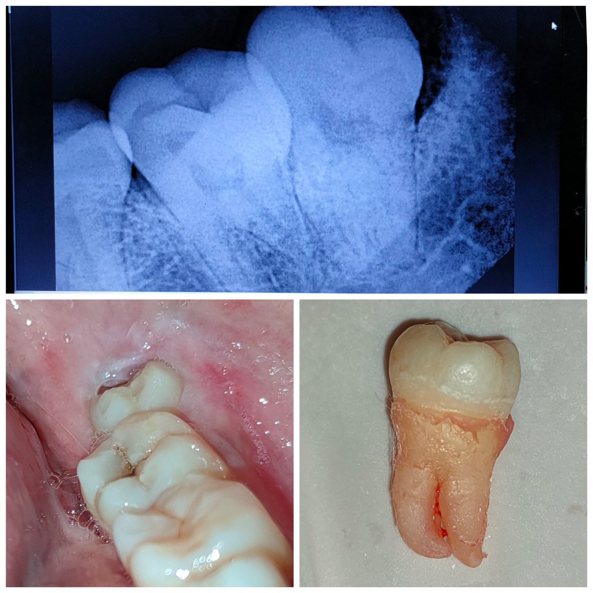 RahulThanvi's tweet photo. Exodontia. #wisdomtooth #thirdmolar https://t.co/eRi1Fs6uoI