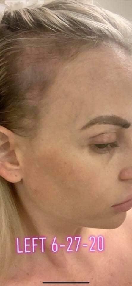 Testimonial : 👏👏
I was so hesitant to try this, and NEVER thought I would share photos of it, but I am so amazed! 

I’ve struggled with hair loss for years and years... tried everything!! nothing... nothing has worked!! This really is like liquid gold!! smart.bio/hltheewithshar…