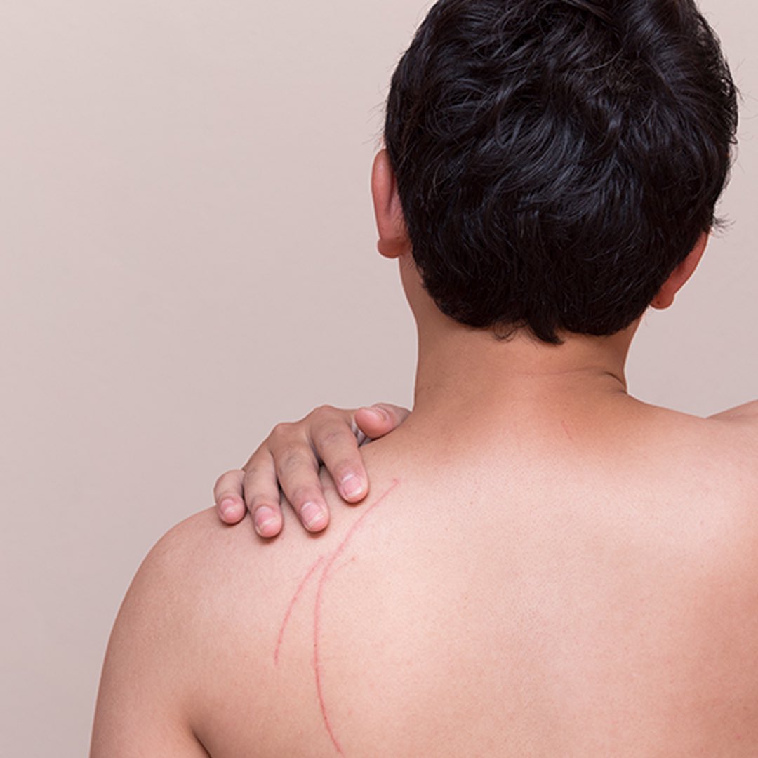 Research reveals clues to how a molecule improves appearance of surgery scars
lnkd.in/gPvrkBtx
#scars #scarring #surgicalscars #scarappeareance #scarhealing #scarimprovement #collagen #fibroblasts #alphaCT1 #FederationofAmericanSocietiesforExperimentalBiology  #research