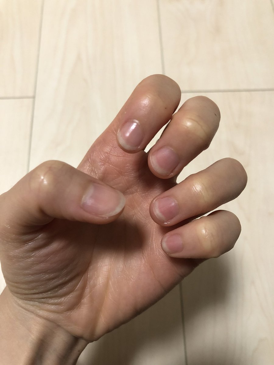 tos_mookzii's tweet image. โน้ตไว้มารีเช๊ค ทำตามทวิตด้านล่าง คืออนากให้เนื้อเล็บสีชมพูยาวเพิ่มขึ้นมอีก เอานิ้วชี้เป็นตัววัด เริ่ม 0.8 เซน ตะไบเล็บแทนการตัดแล้วใช้เซรั่มของอินนิสฟรีกับตัวเคลือบบำรุง รออัพเดตอีก 3 เดือน