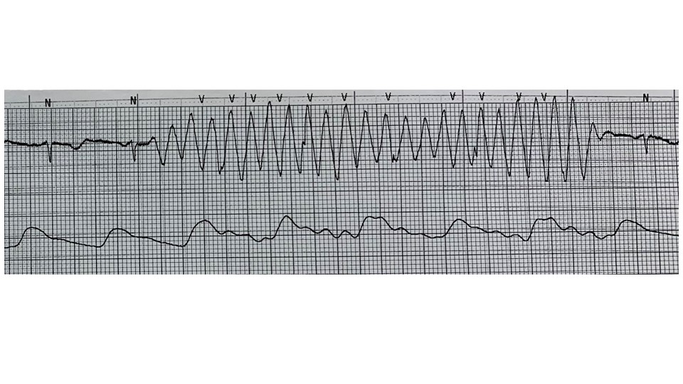 Alan Sugrue, MB BCh (@dralansugrue) on Twitter photo Called last night to help with VT management. Nice example of artifact so reassured. Great discussion at our morning teaching, with reminder about this NEJM classic paper by <a href="/DrBradleyKnight/">Bradley Knight</a>
nejm.org/doi/full/10.10…
<a href="/PennCardiology/">Penn Cardiology</a> Called last night to help with VT management. Nice example of artifact so reassured. Great discussion at our morning teaching, with reminder about this NEJM classic paper by <a href="/DrBradleyKnight/">Bradley Knight</a>
nejm.org/doi/full/10.10…
<a href="/PennCardiology/">Penn Cardiology</a>