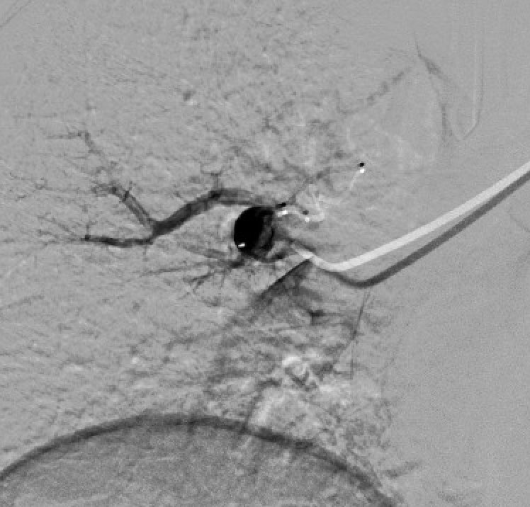 #PAVM How do you treat? Feeding artery (FA) plug versus Nidus + FA versus other? @EmoryRadiology <a href="/EmoryIRad/">Emory University Interventional Radiology</a>