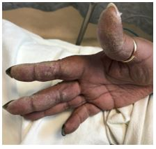 ATSCPAssembly's tweet photo. #TeachingTuesday challenge from ATS Quick Hits
48 YO F with sarcoidosis β‘οΈ worsening DOE, cough.
ANA 1:320, aldolase 9.1, anti-PL12 antibody +, Anti-SSA+
Exam findings and CT chest images attached. https://t.co/iusEGpZr5L