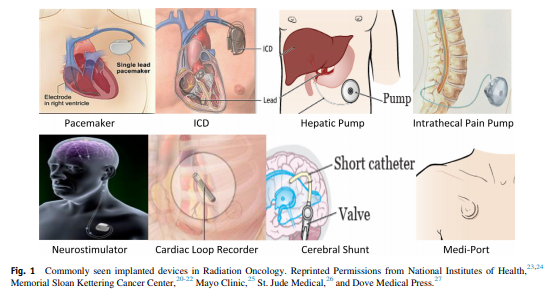 MSK_RadOnc's tweet image. New in @ASTRO_org #AdvancesRO, a @MskMedPhys led review of the management of patients with commonly seen #implanteddevices, summarizing the workflow for identifying and planning #radiation #radonc #medPhys ☢️🫀⚡️
advancesradonc.org/article/S2452-…