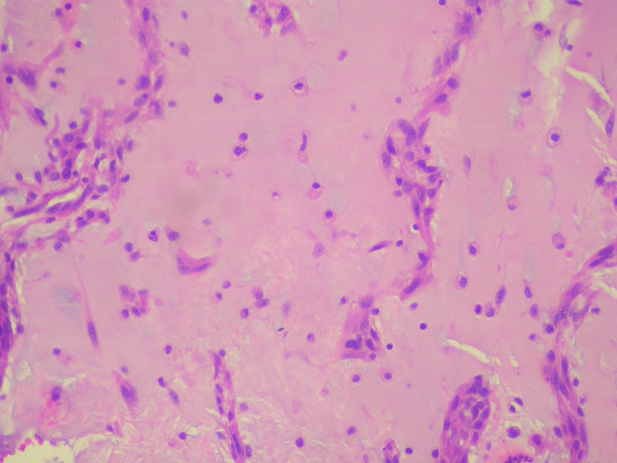 ashokparameswar's tweet photo. For a change from infective conditions. 45 year old lady with a left atrial myxoid mass  excised. Opinions? https://t.co/UiW33pDVaf