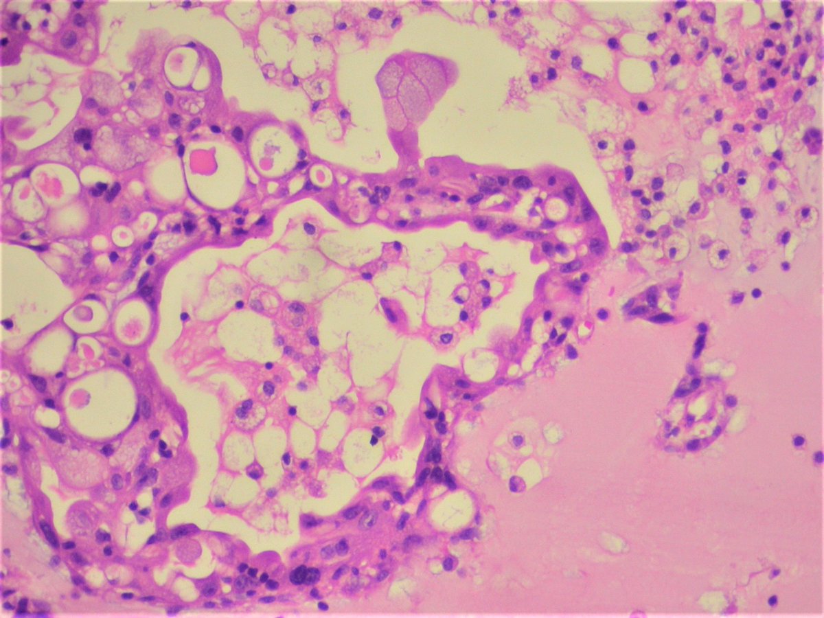 ashokparameswar's tweet photo. For a change from infective conditions. 45 year old lady with a left atrial myxoid mass  excised. Opinions? https://t.co/UiW33pDVaf