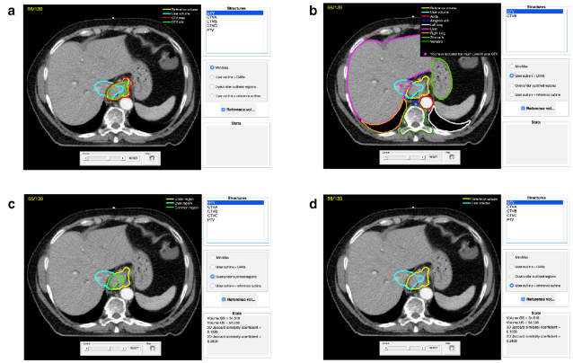 BIR Journals (@bjr_radiology) on Twitter photo FIELDRT: an open-source platform for the assessment of target volume delineation in radiation therapy
bit.ly/3fNYsXQ
#Radiotherapy #RadOnc <a href="/ConcettaPiazze3/">Concetta Piazzese</a> FIELDRT: an open-source platform for the assessment of target volume delineation in radiation therapy
bit.ly/3fNYsXQ
#Radiotherapy #RadOnc <a href="/ConcettaPiazze3/">Concetta Piazzese</a>