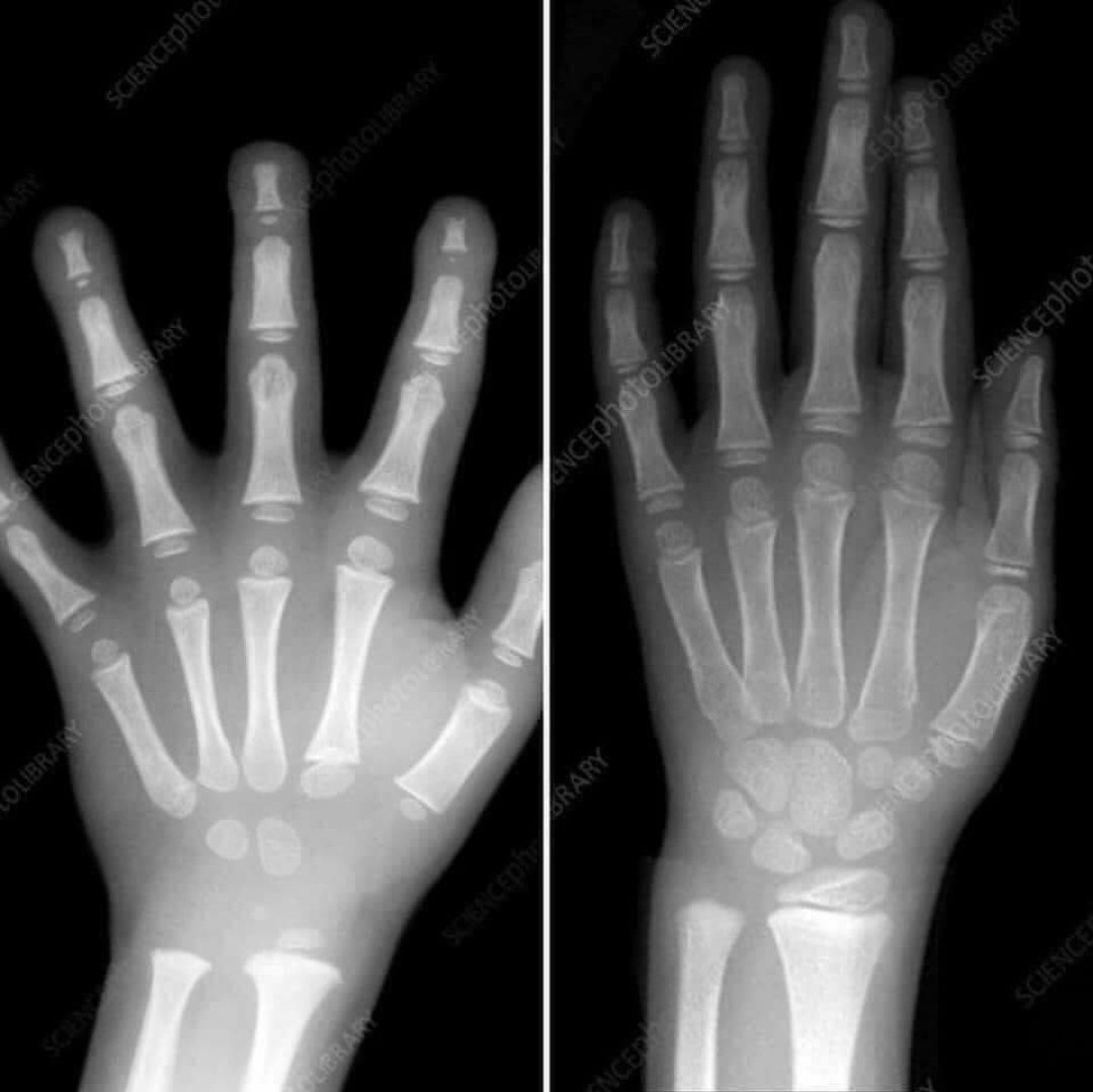 Soldaki okul öncesi bir çocuğun el röntgeni ve sağdaki 7 yaşındaki bir çocuğun el röntgeni. Çocukların hazirbulunusluklarin ne kadar önemli olduğunu daha iyi gösteriyor. Okul öncesi eğitim ile çocuk her yönle gelişip ilkokula hazır hale geliyor.
 <a href="/tcmeb/">Millî Eğitim Bakanlığı</a> <a href="/kastamonumem/">Kastamonu İl Millî Eğitim Müdürlüğü</a>