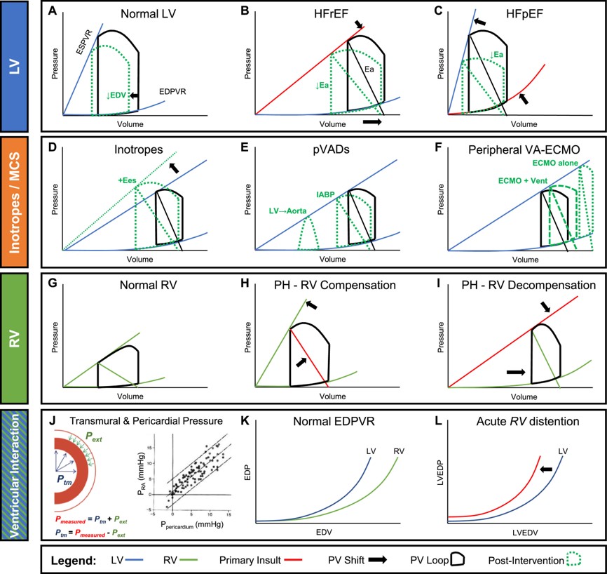 Robert Mentz, MD (@robmentz) on Twitter photo Incredible paper <a href="/JCardFail/">Journal of Cardiac Failure</a> - "Hemodynamics for the HF Clinician: A State-of-the-Art Review". Important read for everyone interested in HF by Drs. Hsu, Fang & Borlaug - You'll learn a ton from this!
<a href="/HFSA/">HFSA</a> #cardiotwitter <a href="/UUtah/">University of Utah</a> <a href="/hopkinsheart/">Johns Hopkins Cardiology</a> <a href="/MayoClinic/">Mayo Clinic</a>
onlinejcf.com/article/S1071-… Incredible paper <a href="/JCardFail/">Journal of Cardiac Failure</a> - "Hemodynamics for the HF Clinician: A State-of-the-Art Review". Important read for everyone interested in HF by Drs. Hsu, Fang & Borlaug - You'll learn a ton from this!
<a href="/HFSA/">HFSA</a> #cardiotwitter <a href="/UUtah/">University of Utah</a> <a href="/hopkinsheart/">Johns Hopkins Cardiology</a> <a href="/MayoClinic/">Mayo Clinic</a>
onlinejcf.com/article/S1071-…