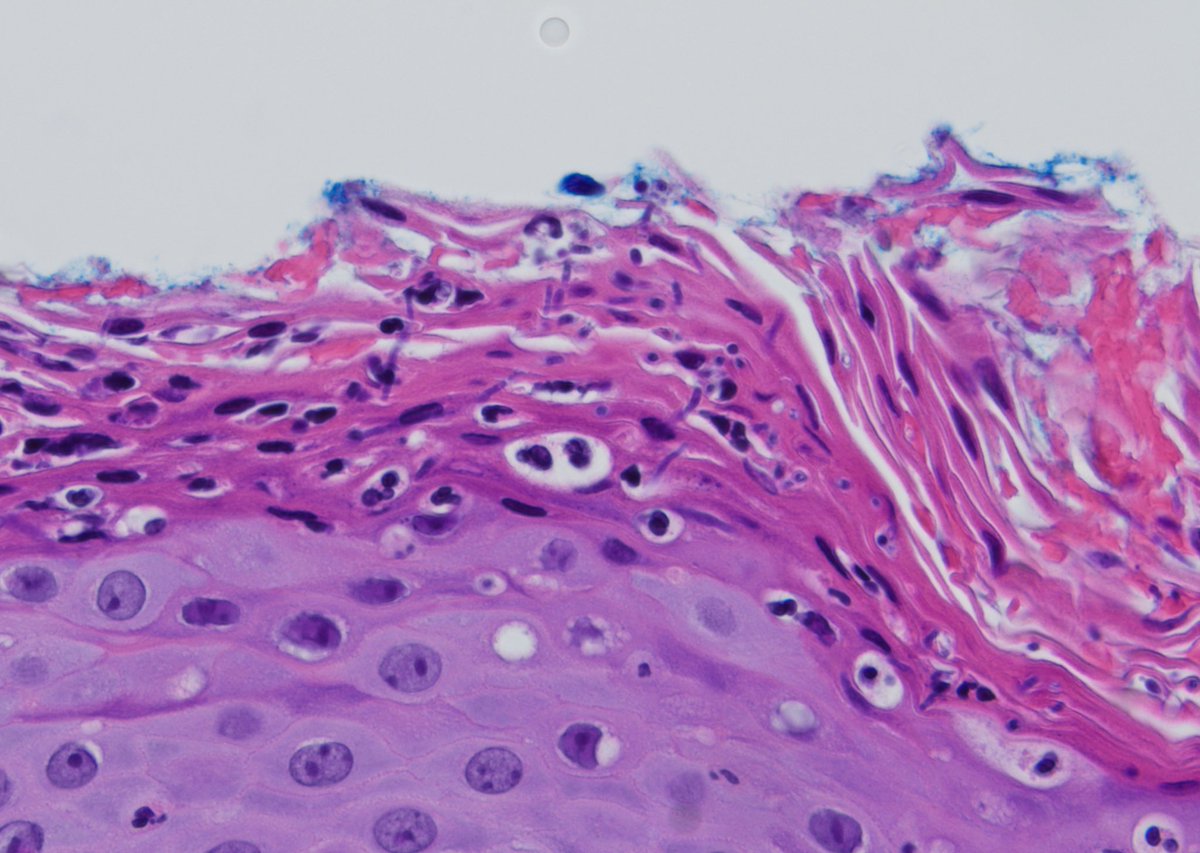 A fun one. When you see that ragged stratum corneum with neutrophils at low power, look closer. #dermpath