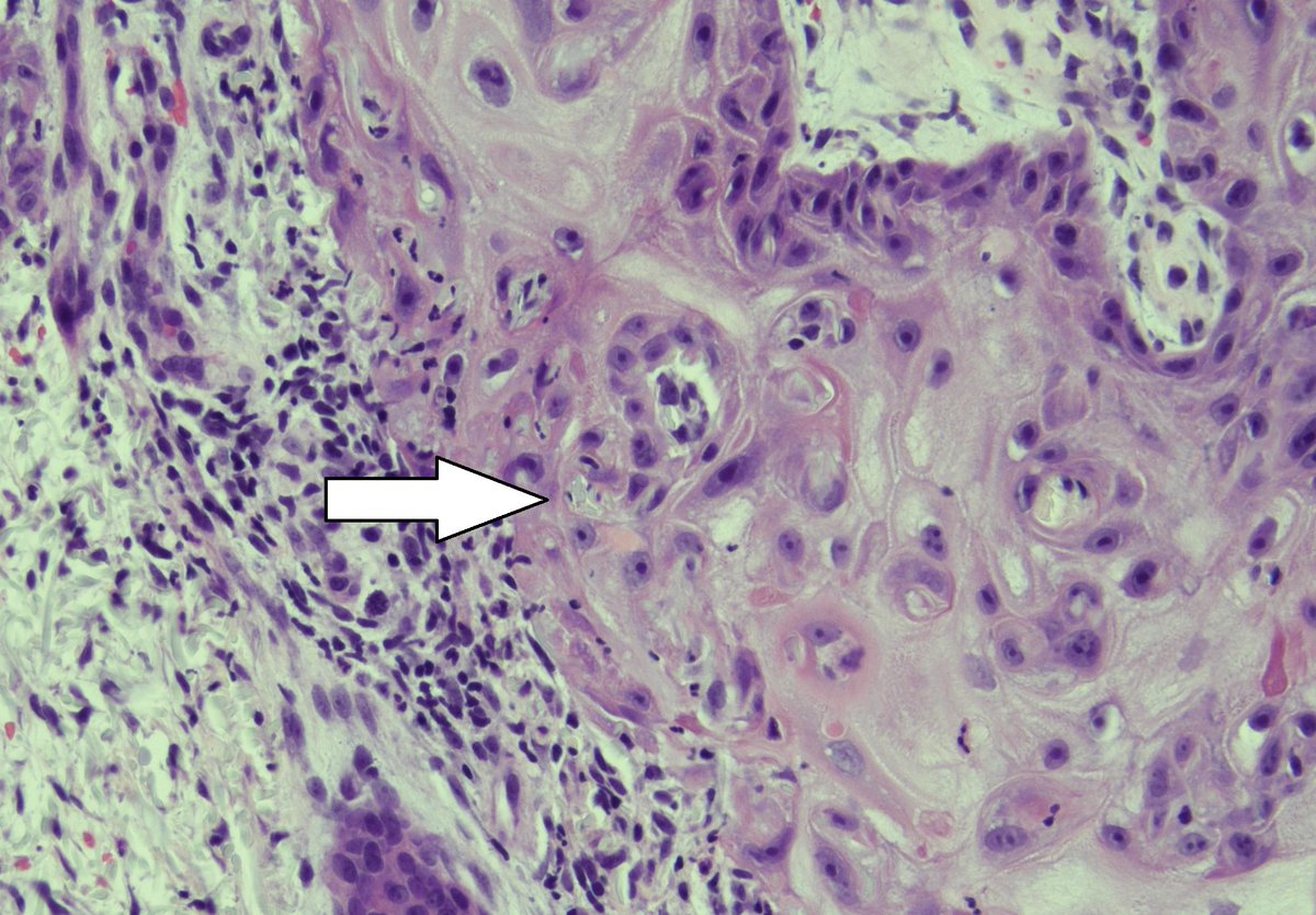 Great elastin trapping in a KA #dermpath
