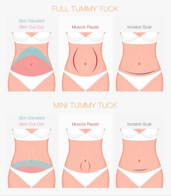 Tummy Tuck (Abdominoplasty) - Toronto Cosmetic Surgery