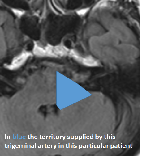 eytanraz's tweet photo. What exact territory does this trigeminal artery supply? ๐Look at the #dynaCT, in this case demonstrating clear vital๐brainstem supply๐ง #BANANA @neuroangio1 https://t.co/5TBmoOxl9T