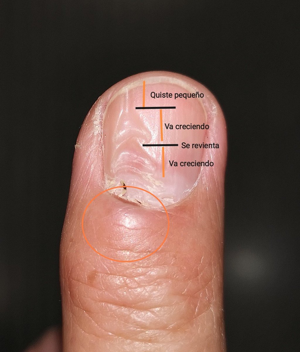 Lo que nos cuentan las uñas 💅 
Un surco irregular es patognomónico de un pseudoquiste mixoide. Conforme crece, comprime más la matriz y el surco se hace más ancho. Cuando el quiste se revienta, el surco vuelve a ser estrecho.
#dermatology #nails