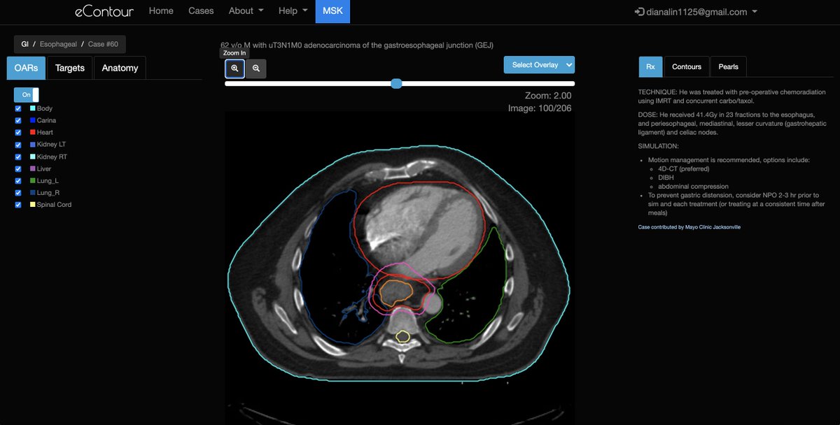 eContourRadOnc's tweet image. A big thank you 🙏 to the 🌟 #radonc residents who submitted our top 3 #econtour cases!

1⃣@JeremyPriceMD1 - GBM case 👉 staging.econtour.org/cases/116
2⃣@WaddleMd - Esophageal case 👉 staging.econtour.org/cases/60
3⃣@ChaurasiaMD - Rectal case 👉staging.econtour.org/cases/95