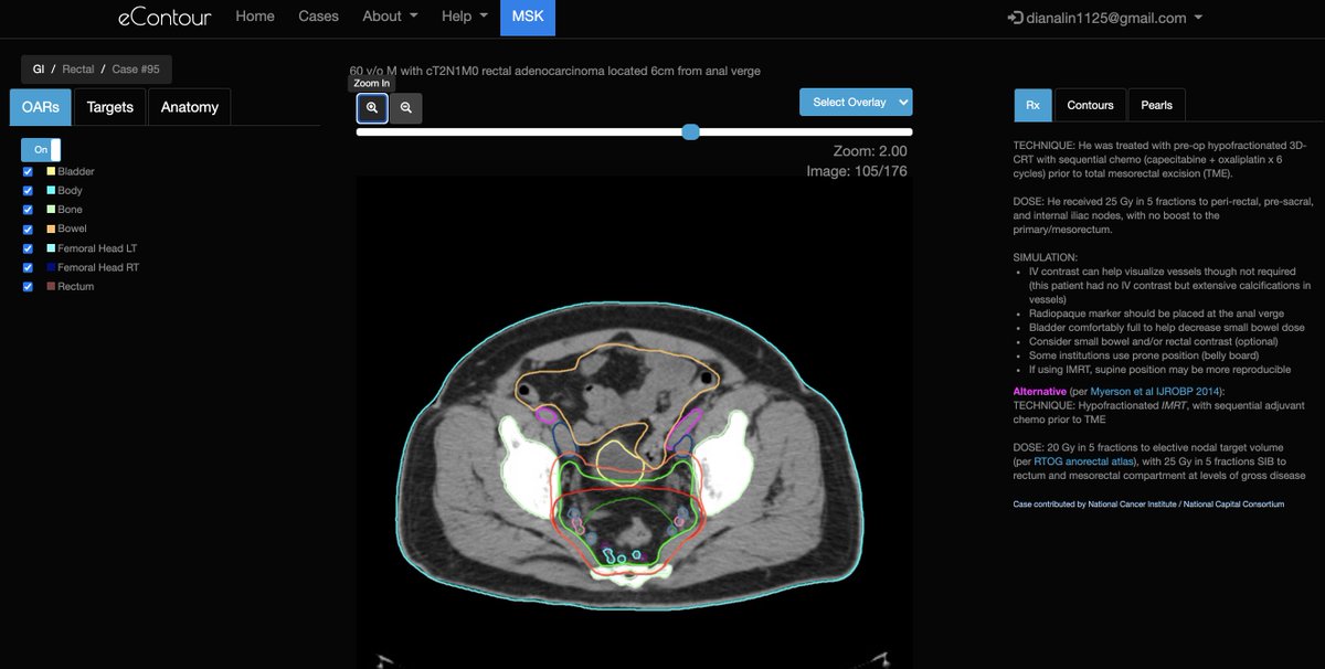 eContourRadOnc's tweet image. A big thank you 🙏 to the 🌟 #radonc residents who submitted our top 3 #econtour cases!

1⃣@JeremyPriceMD1 - GBM case 👉 staging.econtour.org/cases/116
2⃣@WaddleMd - Esophageal case 👉 staging.econtour.org/cases/60
3⃣@ChaurasiaMD - Rectal case 👉staging.econtour.org/cases/95