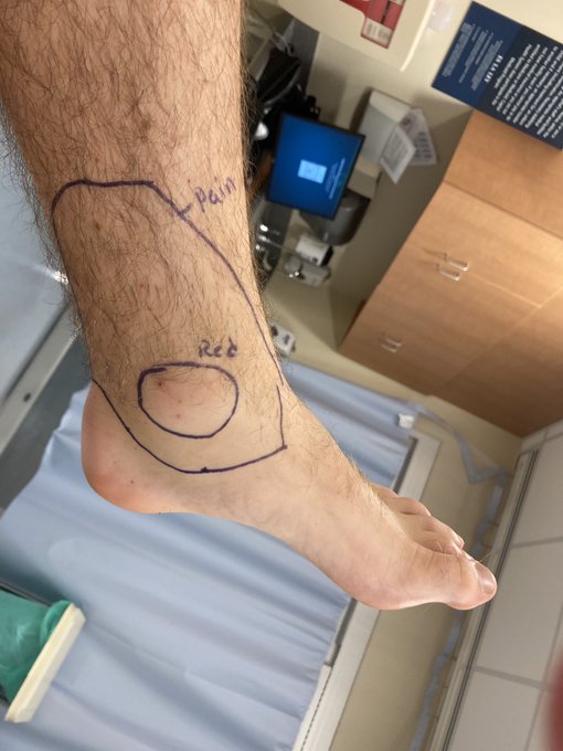 NJ copperheads: Venomous snake bite lands New Jersey man in the hospital -  6abc Philadelphia